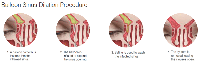 4 Steps in Sinus Balloon Procedure
