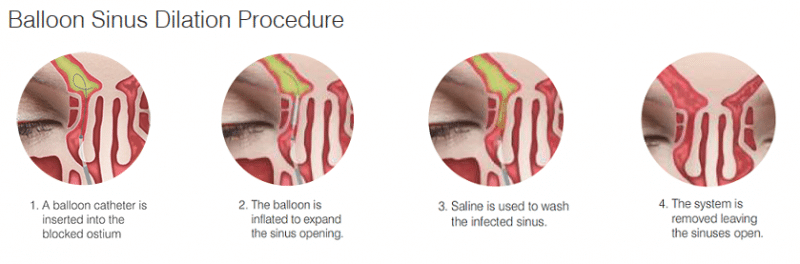 4 Steps of Sinus Dilation Procedure